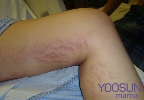 Nguyên nhân bị rạn da ở đầu gối