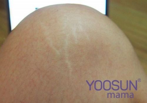 Nguyên nhân rạn da đầu gối