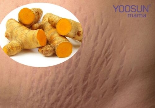 Vết rạn da do tập gym