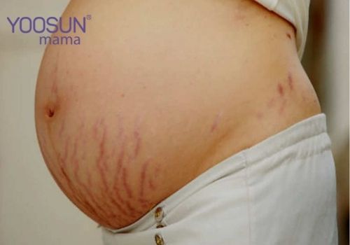 Bị rạn da đỏ có tự hết không