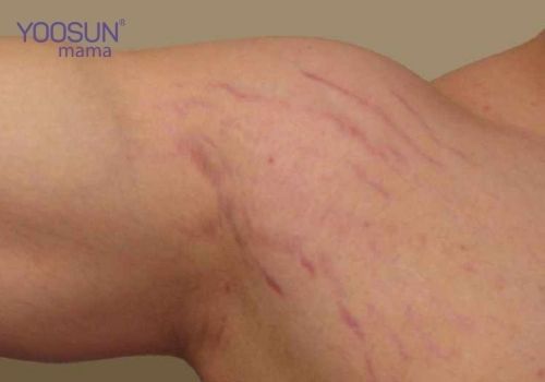 Bị rạn da màu đỏ ở chân