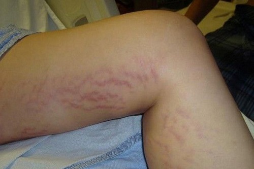 Cách chữa vết rạn da màu đỏ