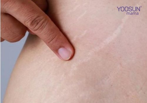 mỡ trăn trị rạn da được không