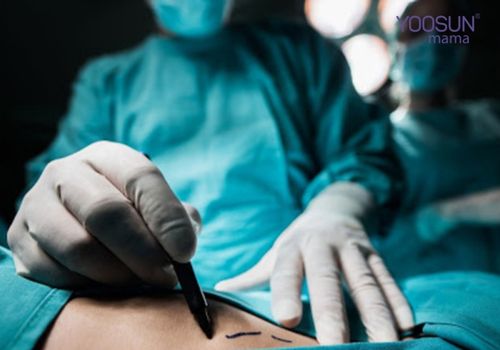 Phẫu thuật cắt bỏ rạn da cơ thể