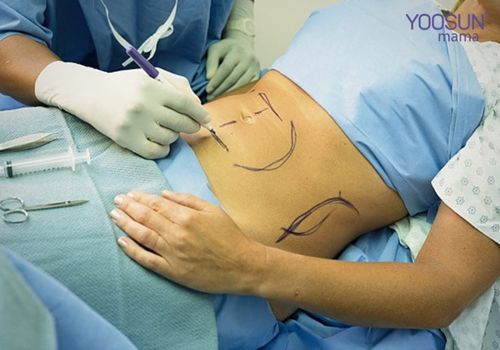 Phẫu thuật rạn da bụng