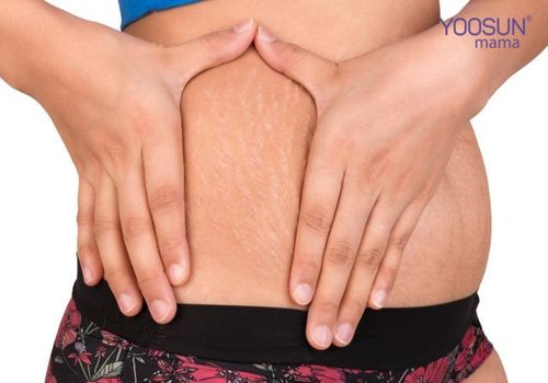 Phẫu thuật trị rạn da sau sinh