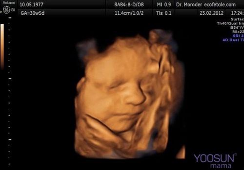 siêu âm 3d là gì