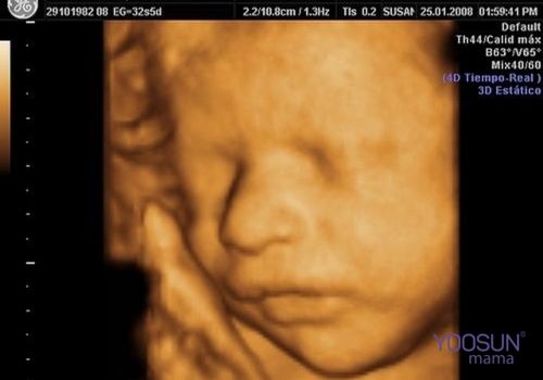 siêu âm 4d không thấy xương mũi