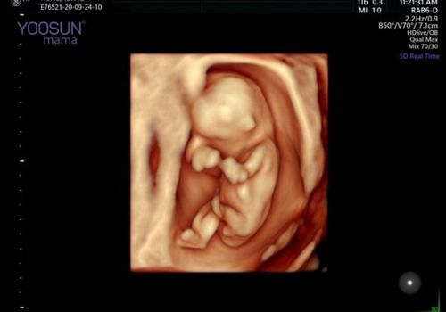 siêu âm 5d ở tuần bao nhiều