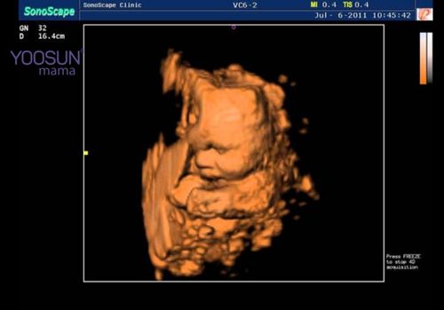 siêu âm doppler thai là gì