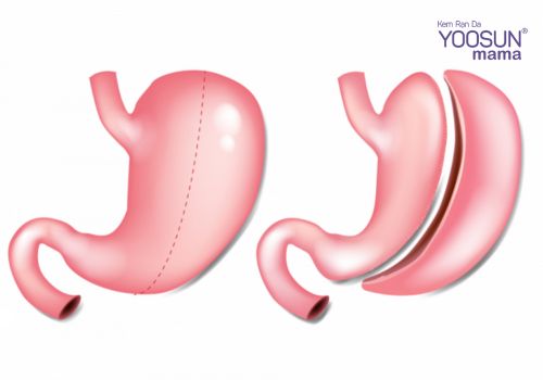 Chi phí cắt dạ dày giảm cân bao nhiêu tiền  Chi phí cắt dạ dày giảm cân