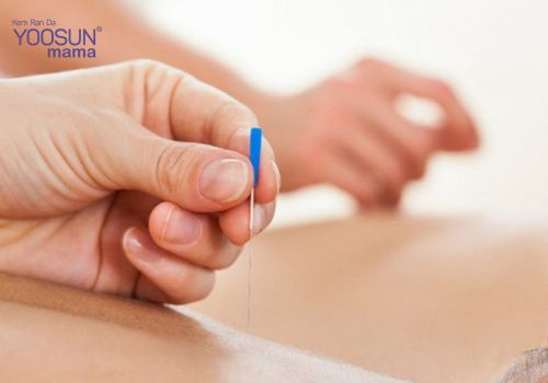 Phương pháp cấy chỉ giảm cân có tốt không vậy? Phương pháp cấy chỉ giảm cân có tốt không