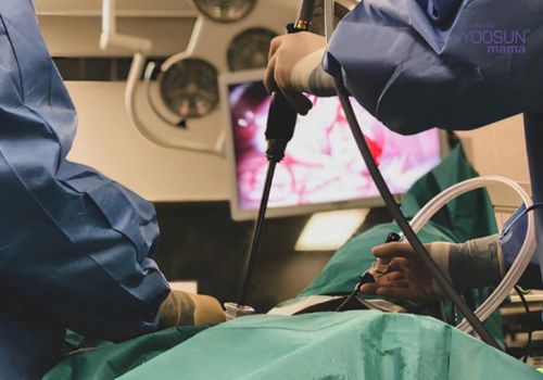 chửa ngoài dạ con có phải mổ không