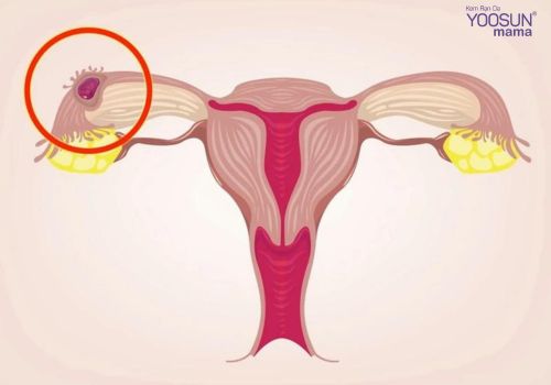 chửa ngoài dạ con là gì