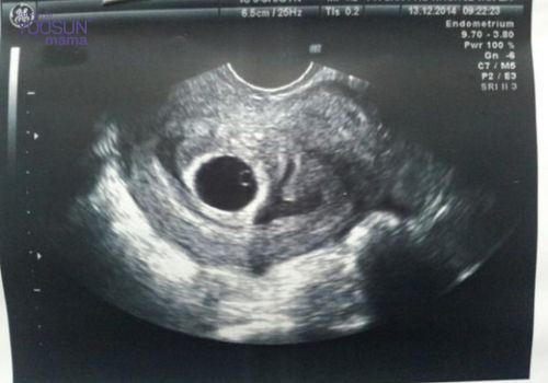 thai rỗng có nghén không