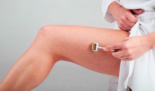 Chữa rạn da bằng lăn kim