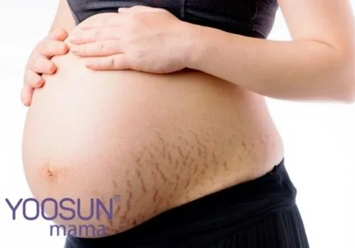 Bà bầu bị rạn da tháng thứ mấy