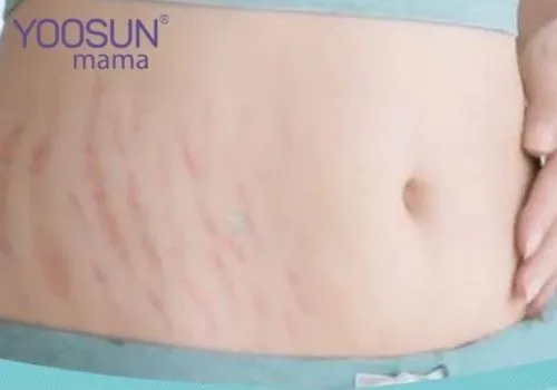 Bị rạn da ở phụ nữ mang thai