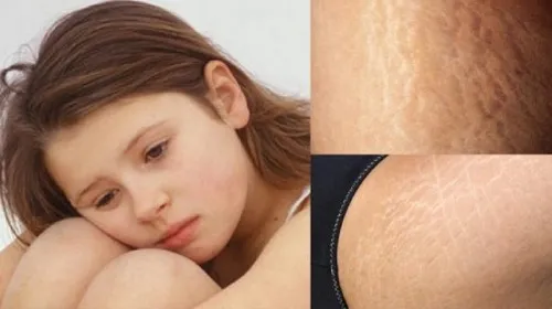 Cách làm hết rạn da ở tuổi dậy thì