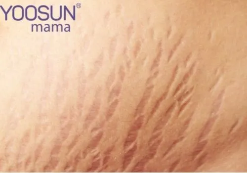 Hình ảnh bà bầu bị rạn da