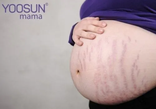 Hình ảnh mẹ bầu bị rạn da