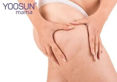 Hình ảnh rạn da khi mang bầu