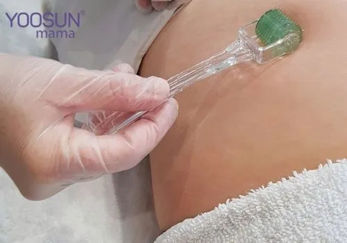 Lăn kim chữa rạn da