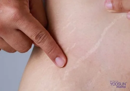 Công nghệ plasma trị rạn da 