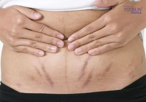 Mẹo chữa rạn da bằng plasma