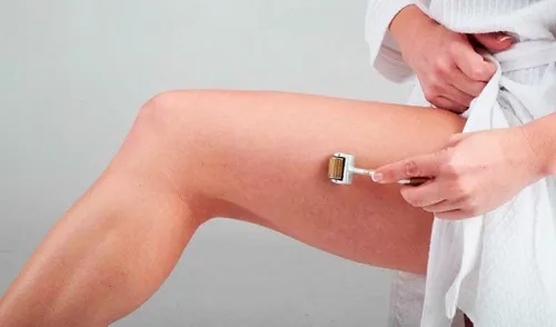 Chữa rạn da bằng lăn kim